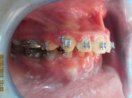 Những tai biến thường gặp trong chỉnh răng